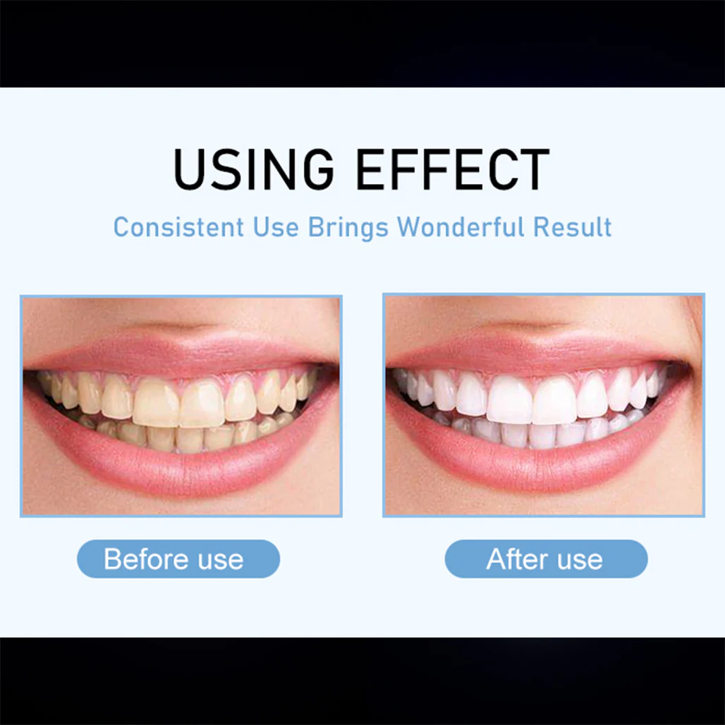 IVISMILE M6 Powerful Teeth Whitening Kit - Image 10